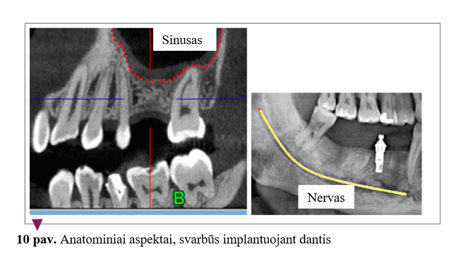 Anatominiai aspektai, svarbūs implantuojant dantis