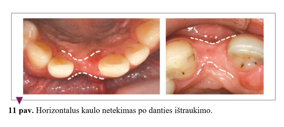 Horizontalus kaulo netekimas po danties ištraukimo.