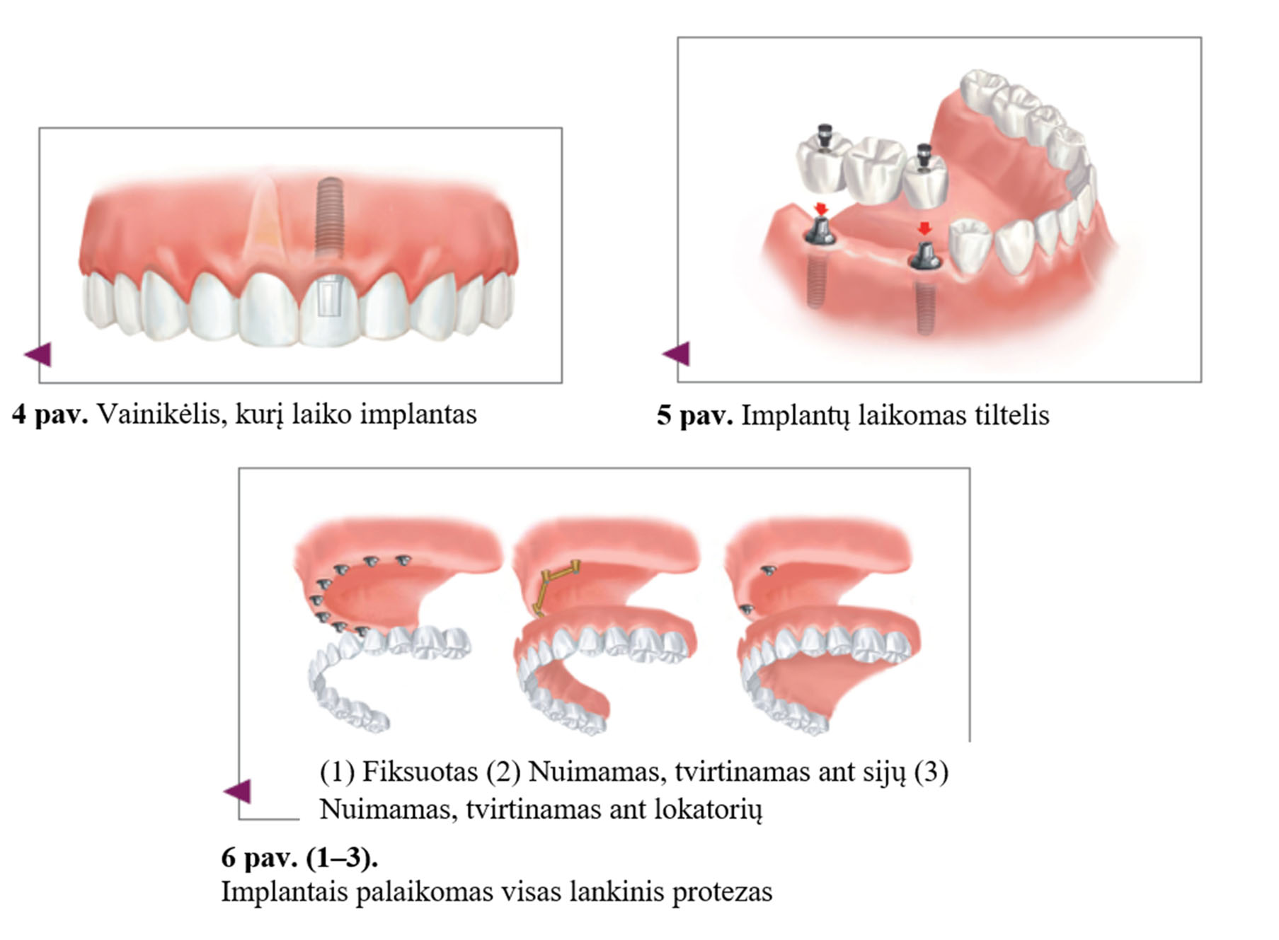 Dantų Implantai