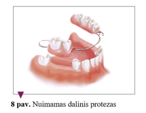 Nuimami prie dantų tvirtinami protezai
